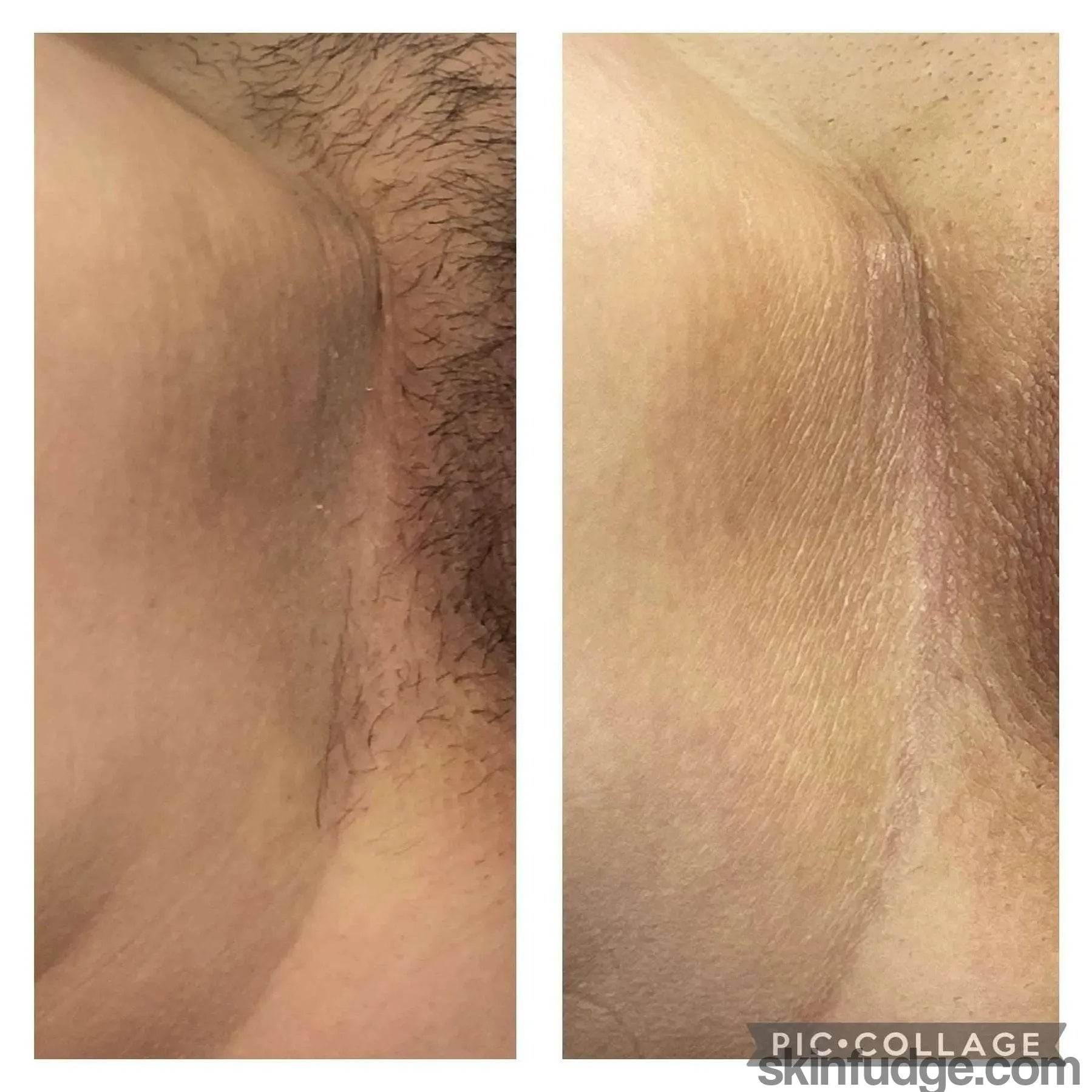 Vaginal Skin Lightening (Vaginal Bleaching) - SKINFUDGE Aesthetics | Painless, No Side Effects, Natural Looking Results