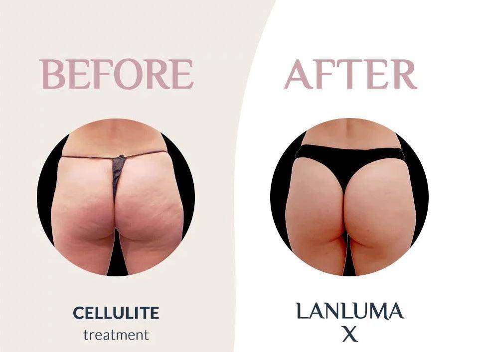 LANLUMA® (Poly-L-lactic acid) - SKINFUDGE Aesthetics | Painless, No Side Effects, Natural Looking Results