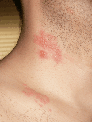 Herpes Zoster (Shingles) Treatment-SKINFUDGE