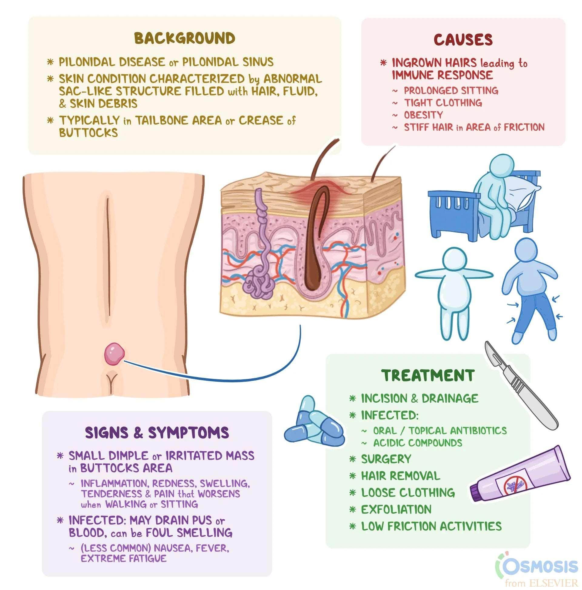 Pilonidal Sinus Buttock Hair Removal - SKINFUDGE Aesthetics | Painless, No Side Effects, Natural Looking Results