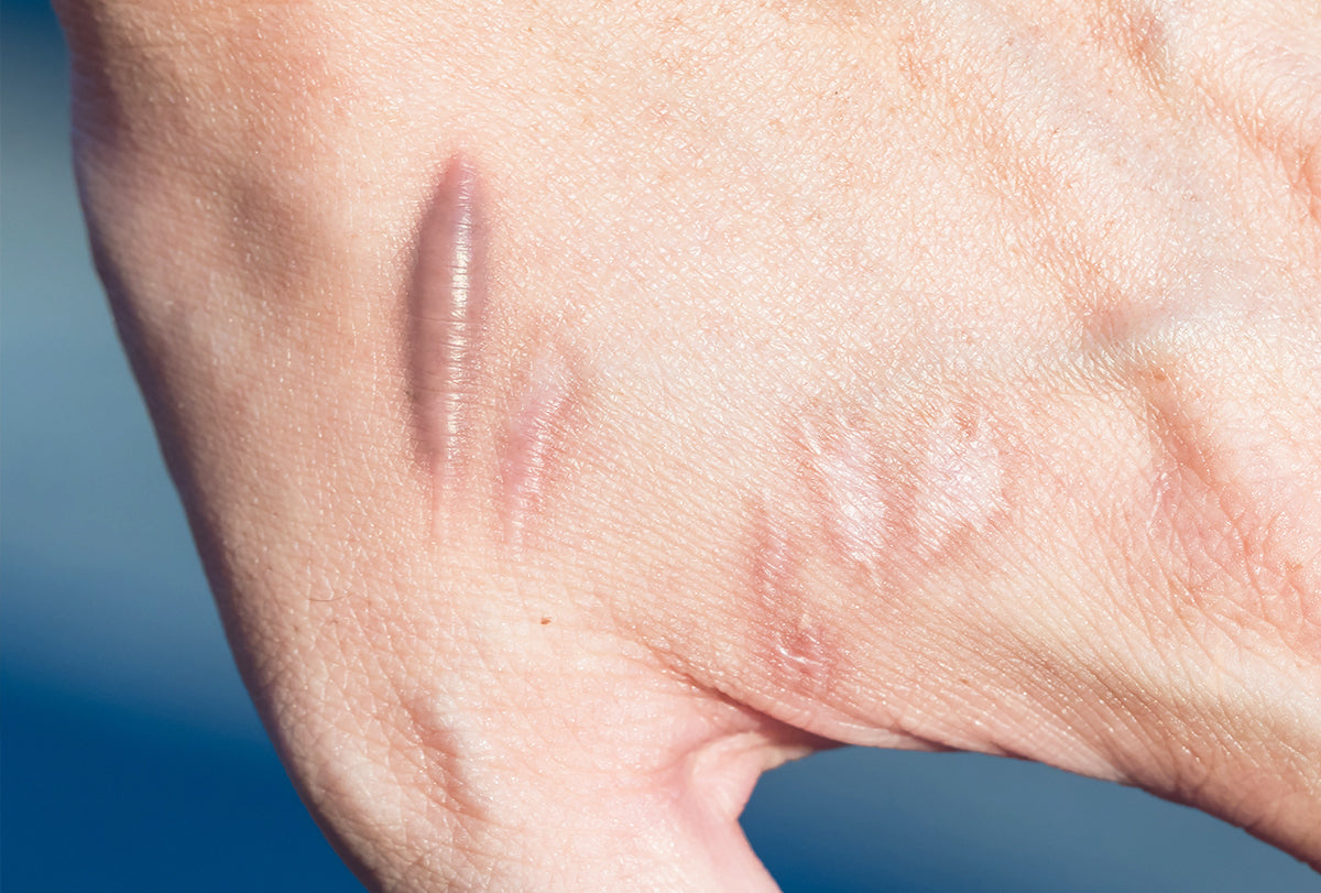 Keloid Treatment – SKINFUDGE Aesthetics | Painless, No Side Effects, Natural Looking Results