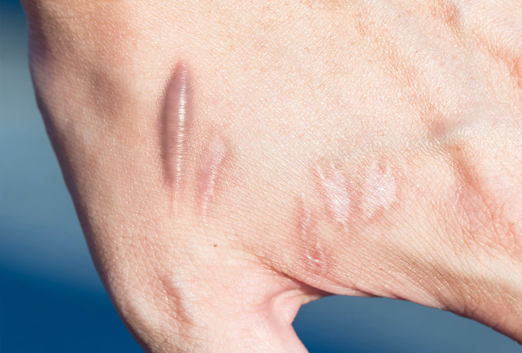 Keloid Treatment
