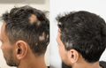 Alopecia Areata Injection - SKINFUDGE Aesthetics | Painless, No Side Effects, Natural Looking Results