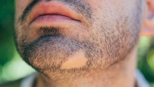 Alopecia Areata Treatment - SKINFUDGE Aesthetics | Painless, No Side Effects, Natural Looking Results