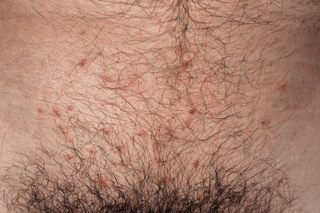 Genital Molluscum Contagiosum Removal Treatment - SKINFUDGE Aesthetics | Painless, No Side Effects, Natural Looking Results