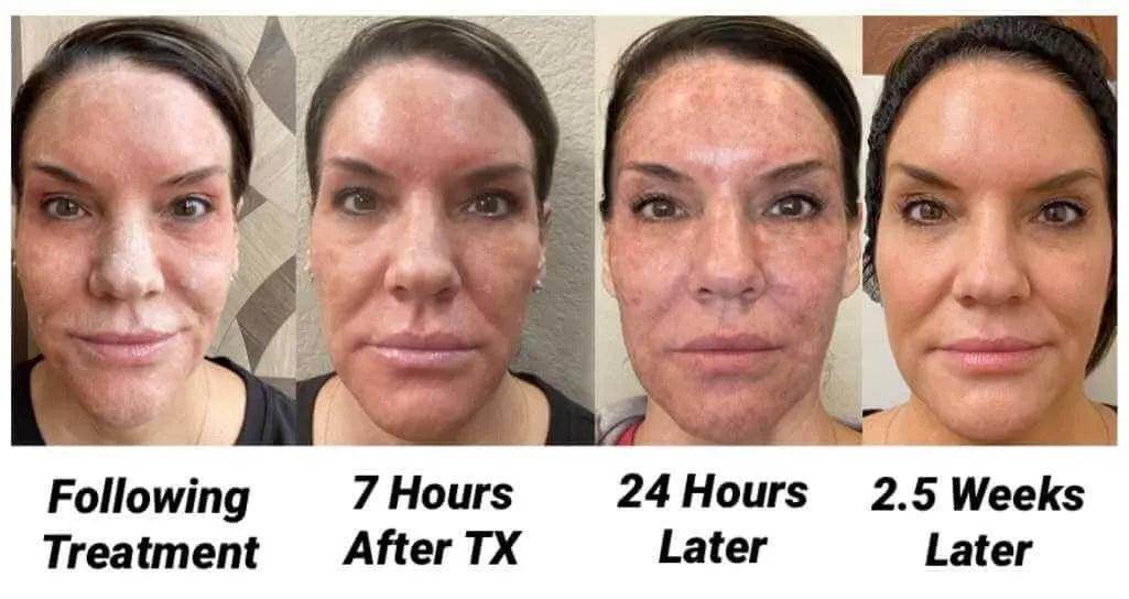 Erbium Yag Laser Resurfacing | Acne Scars, Face Scars, Uneven skin tone - SKINFUDGE Aesthetics | Painless, No Side Effects, Natural Looking Results