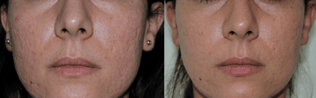 Nano Fat Grafting for Acne Scars (Autologous Fat Grafts) - SKINFUDGE Aesthetics | Painless, No Side Effects, Natural Looking Results