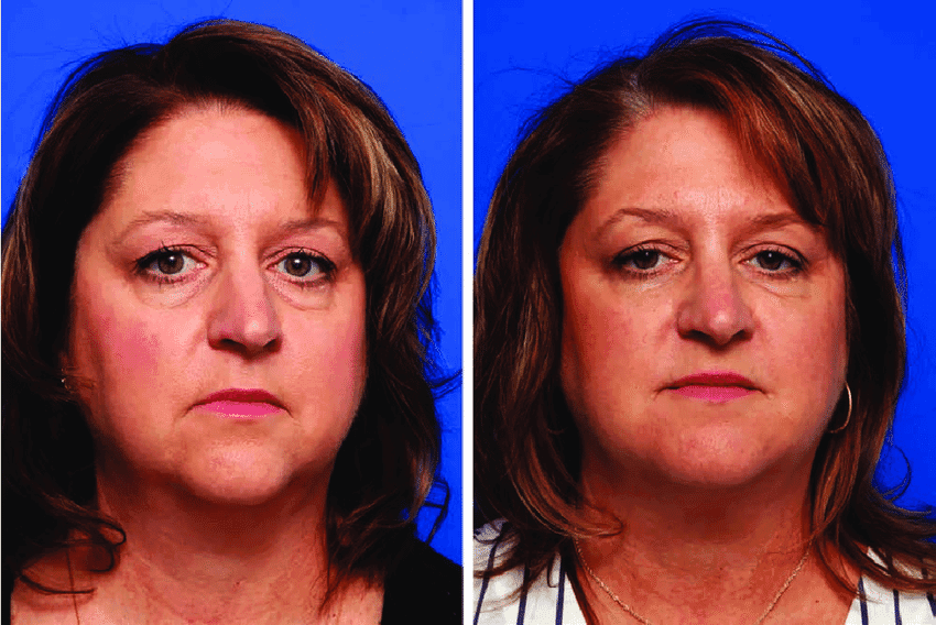 DAO Botox Injection (depressor anguli oris) - SKINFUDGE Aesthetics | Painless, No Side Effects, Natural Looking Results
