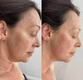 Jawline (double chin) High-intensity focused ultrasound (HIFU) - SKINFUDGE Aesthetics | Painless, No Side Effects, Natural Looking Results