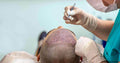 FUE Hair Transplant - SKINFUDGE Aesthetics | Painless, No Side Effects, Natural Looking Results