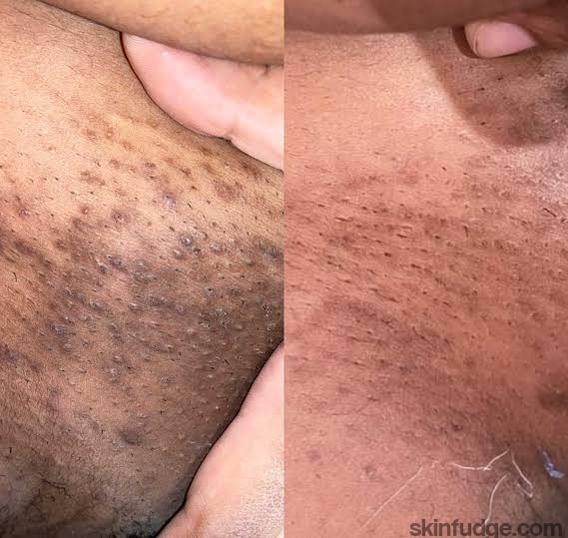 Vaginal Skin Lightening (Vaginal Bleaching) - SKINFUDGE Aesthetics | Painless, No Side Effects, Natural Looking Results
