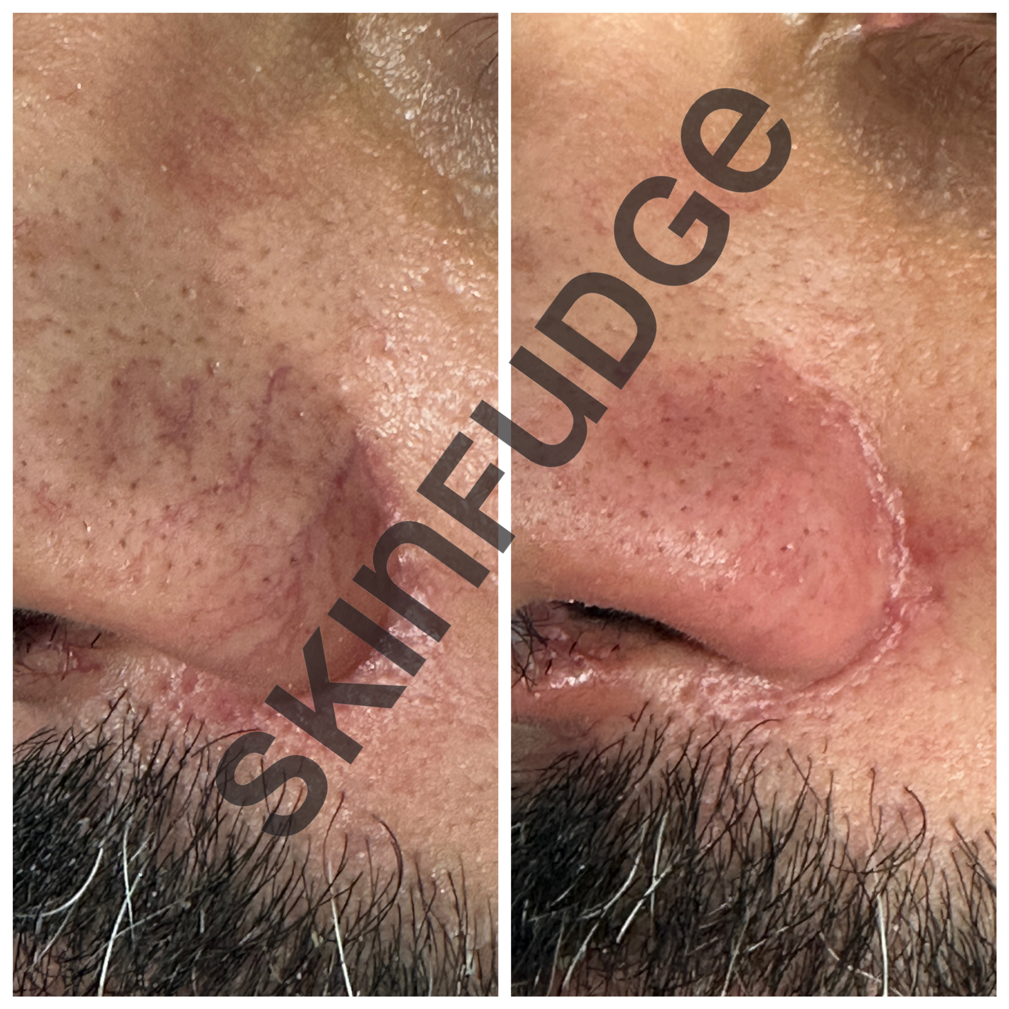 Broken Capillaries / Spider Veins Removal
