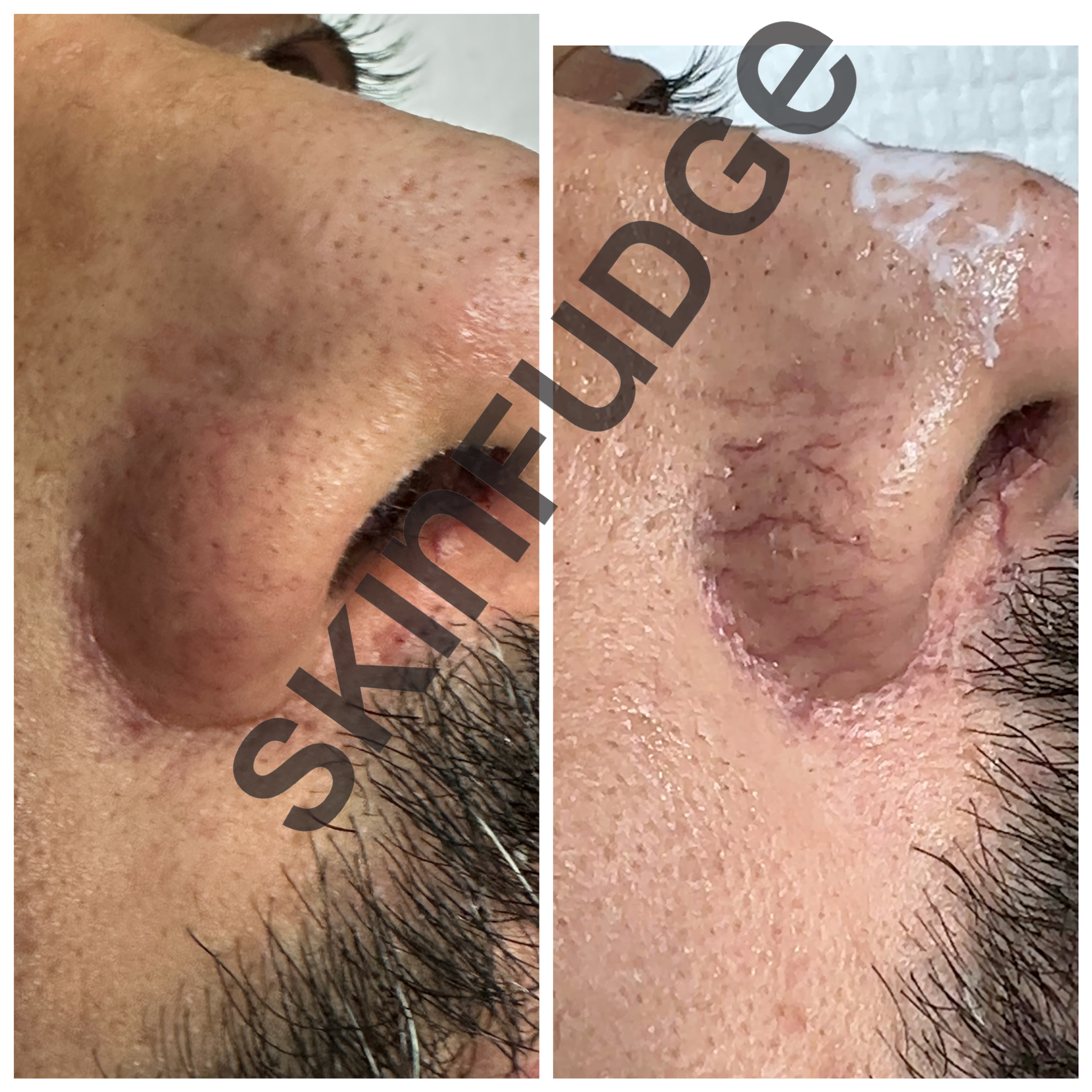 Broken Capillaries / Spider Veins Removal