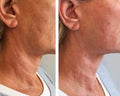 Full Neck High-intensity focused ultrasound (HIFU) - SKINFUDGE Aesthetics | Painless, No Side Effects, Natural Looking Results