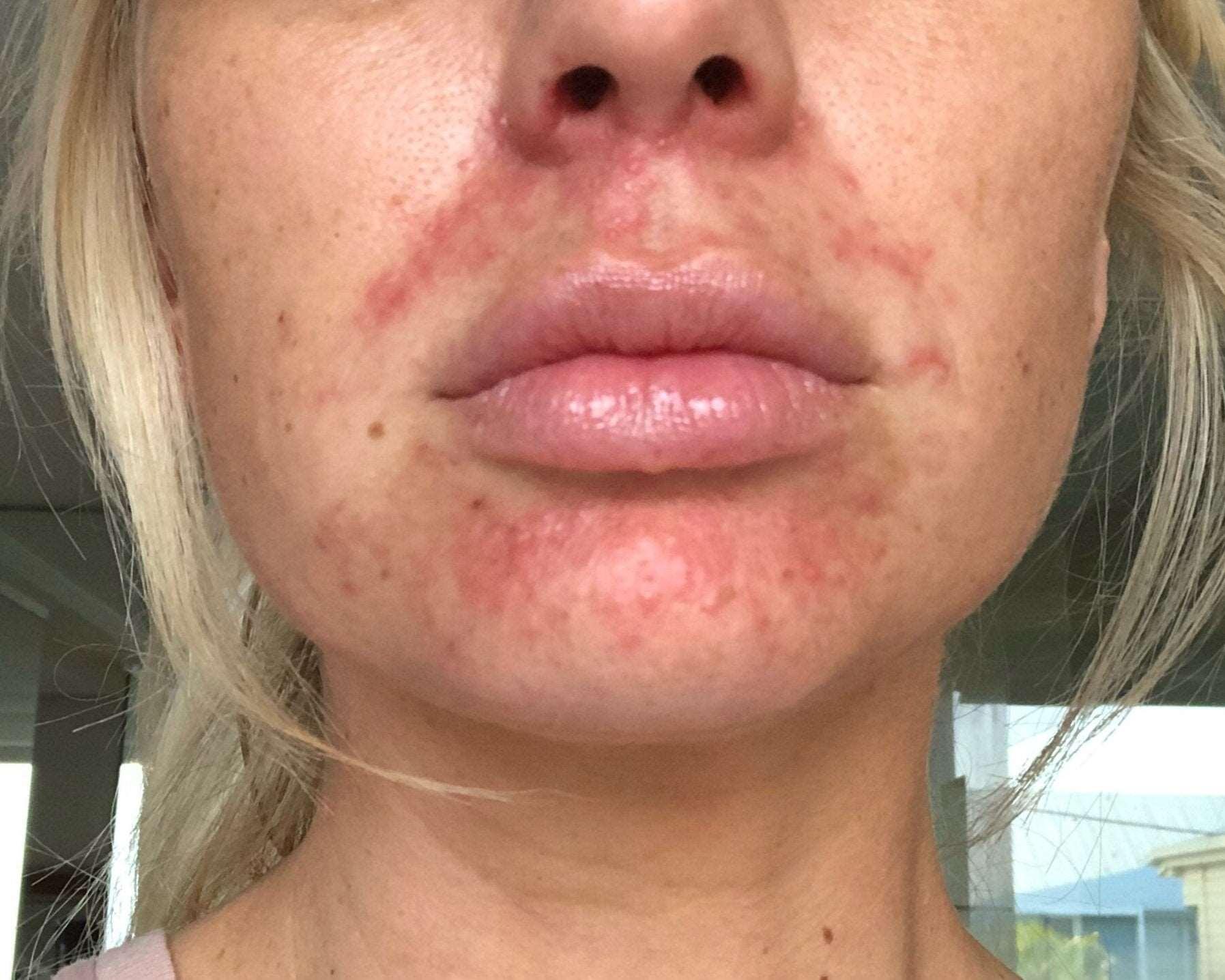 Perioral Dermatitis Treatment-SKINFUDGE
