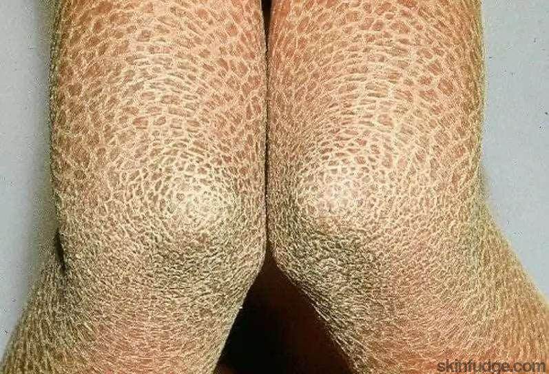 Icthyosis Treatment Consultation - SKINFUDGE Aesthetics | Painless, No Side Effects, Natural Looking Results