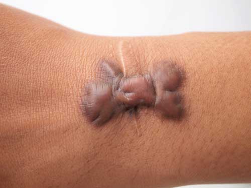 Keloid Treatment