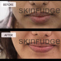 Lip Lightening Procedure - SKINFUDGE Aesthetics | Painless, No Side Effects, Natural Looking Results