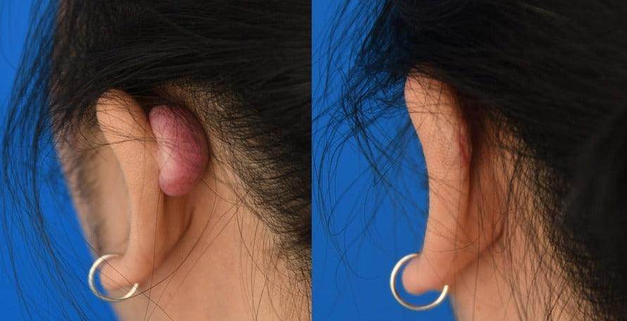 Keloid Laser Treatment - SKINFUDGE Aesthetics | Painless, No Side Effects, Natural Looking Results