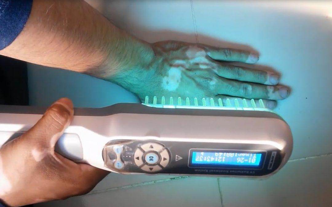 UVB Phototherapy Clinic - SKINFUDGE Aesthetics | Painless, No Side Effects, Natural Looking Results