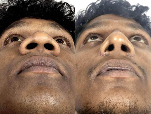 Alarplasty Procedure - SKINFUDGE Aesthetics | Painless, No Side Effects, Natural Looking Results