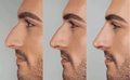 Liquid Rhinoplasty - SKINFUDGE Aesthetics | Painless, No Side Effects, Natural Looking Results