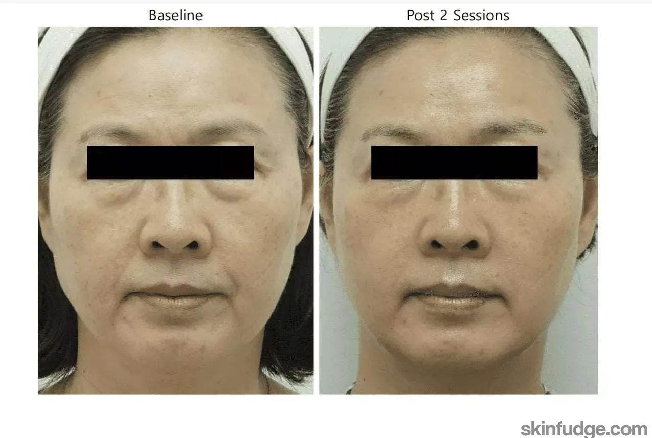 Full Face High-intensity focused ultrasound (HIFU) - SKINFUDGE Aesthetics | Painless, No Side Effects, Natural Looking Results