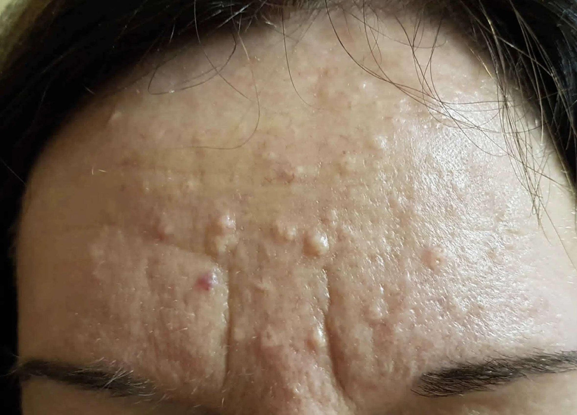 Sebaceous Hyperplasia-SKINFUDGE
