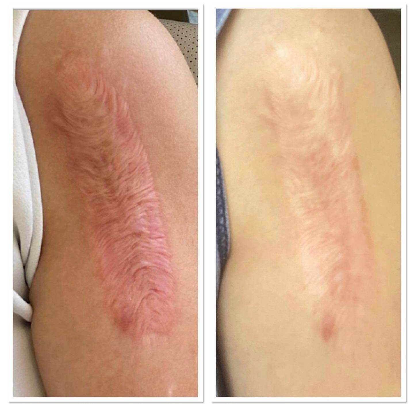 Keloid Laser Treatment - SKINFUDGE Aesthetics | Painless, No Side Effects, Natural Looking Results