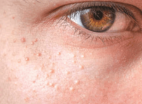Milia: Treatment Options - SKINFUDGE Aesthetics | Painless, No Side Effects, Natural Looking Results