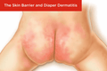 Diaper Dermatitis (Diaper Rash) - SKINFUDGE Aesthetics | Painless, No Side Effects, Natural Looking Results