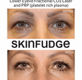 Under-Eye Mesotherapy Treatment - SKINFUDGE Aesthetics | Painless, No Side Effects, Natural Looking Results