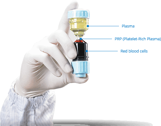 Hair Regrowth Treatment - (Dr. PRP Kit) - SKINFUDGE Aesthetics | Painless, No Side Effects, Natural Looking Results