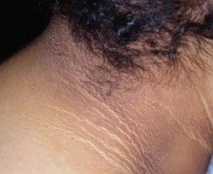 Acanthosis Nigricans - SKINFUDGE Aesthetics | Painless, No Side Effects, Natural Looking Results