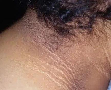 Acanthosis Nigricans-SKINFUDGE
