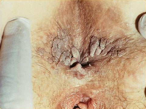 Anal Wart Removal Treatment (Genital) [Condyloma Acuminata]