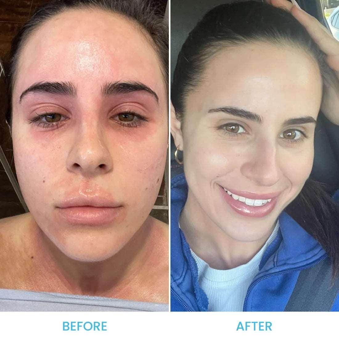 Chemical Peel for Eczema - SKINFUDGE Aesthetics | Painless, No Side Effects, Natural Looking Results