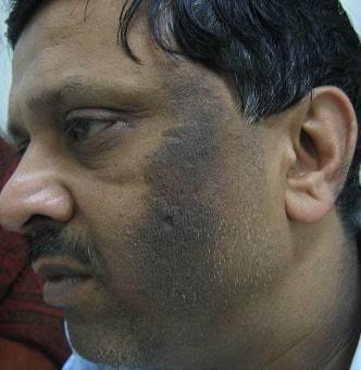 Acanthosis Nigricans-SKINFUDGE