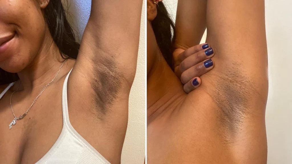Acanthosis Nigricans-SKINFUDGE