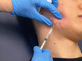 Cortisone Shots for Acne - SKINFUDGE Aesthetics | Painless, No Side Effects, Natural Looking Results