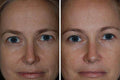 Brow Lift Treatment Surgery - SKINFUDGE Aesthetics | Painless, No Side Effects, Natural Looking Results