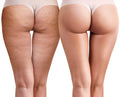 Cellulite Treatment - SKINFUDGE Aesthetics | Painless, No Side Effects, Natural Looking Results