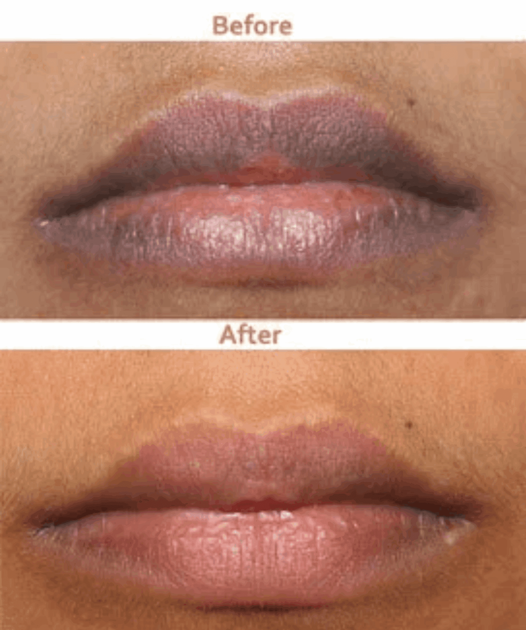 Smoker's Lip Lightening Treatment - SKINFUDGE Aesthetics | Painless, No Side Effects, Natural Looking Results