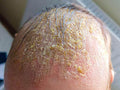 Cradle Cap (Children's Scalp Seborrheic Dermatitis) - SKINFUDGE Aesthetics | Painless, No Side Effects, Natural Looking Results