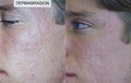 Microdermabrasion / Dermabrasion Treatment - SKINFUDGE Aesthetics | Painless, No Side Effects, Natural Looking Results