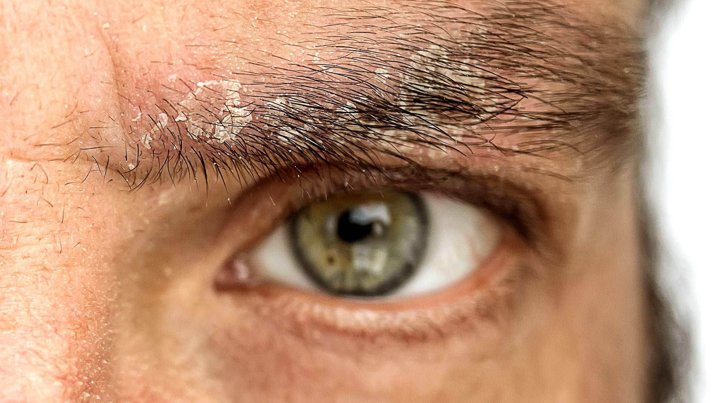 Dandruff Treatment - SKINFUDGE Aesthetics | Painless, No Side Effects, Natural Looking Results