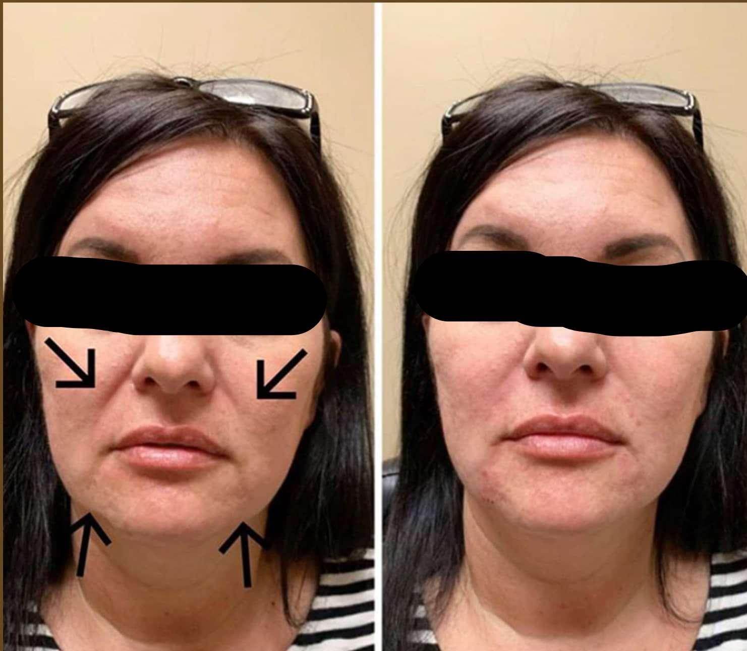 Nasolabial Folds (Smile Lines) Treatment - SKINFUDGE Aesthetics | Painless, No Side Effects, Natural Looking Results
