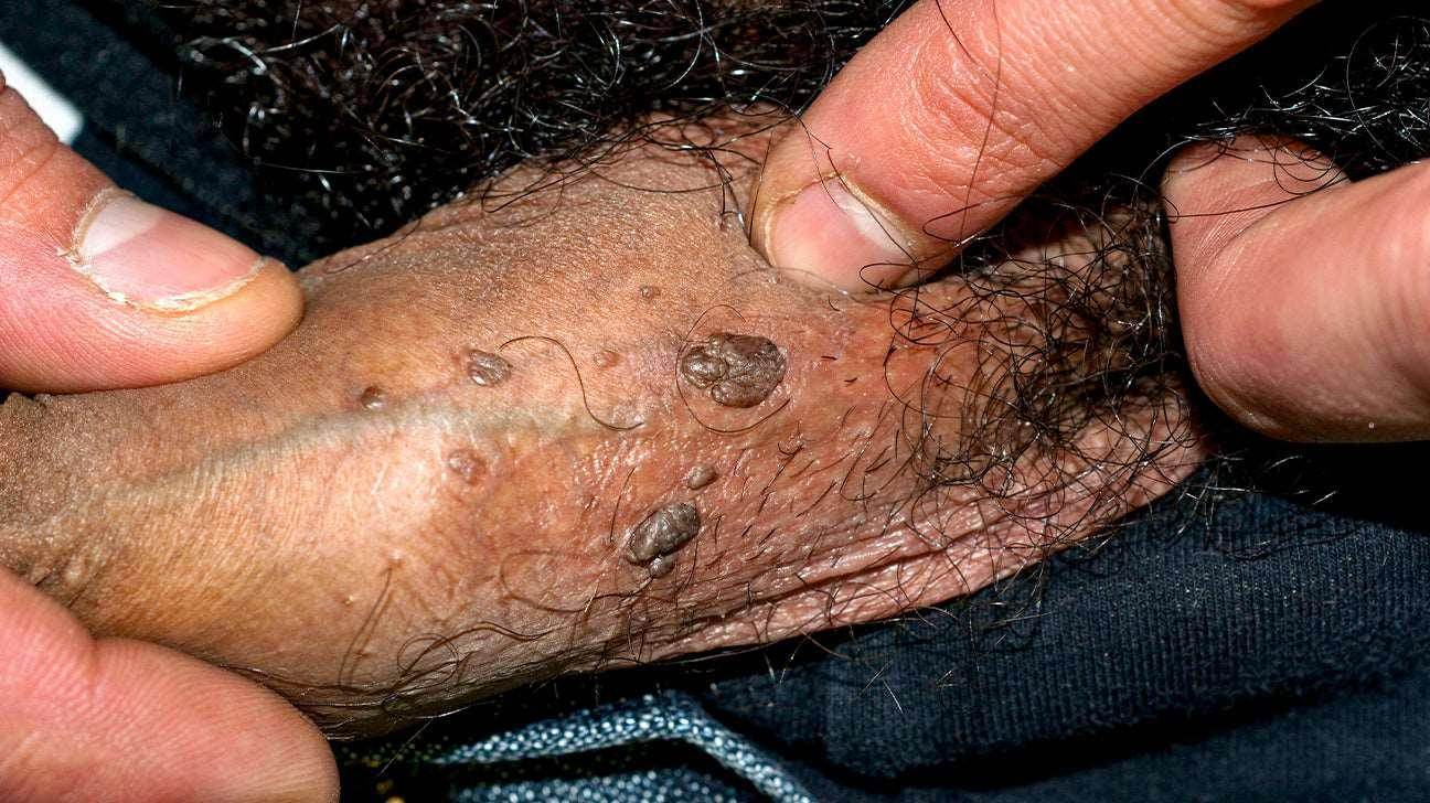 Genital Wart Removal Treatment - SKINFUDGE Aesthetics | Painless, No Side Effects, Natural Looking Results