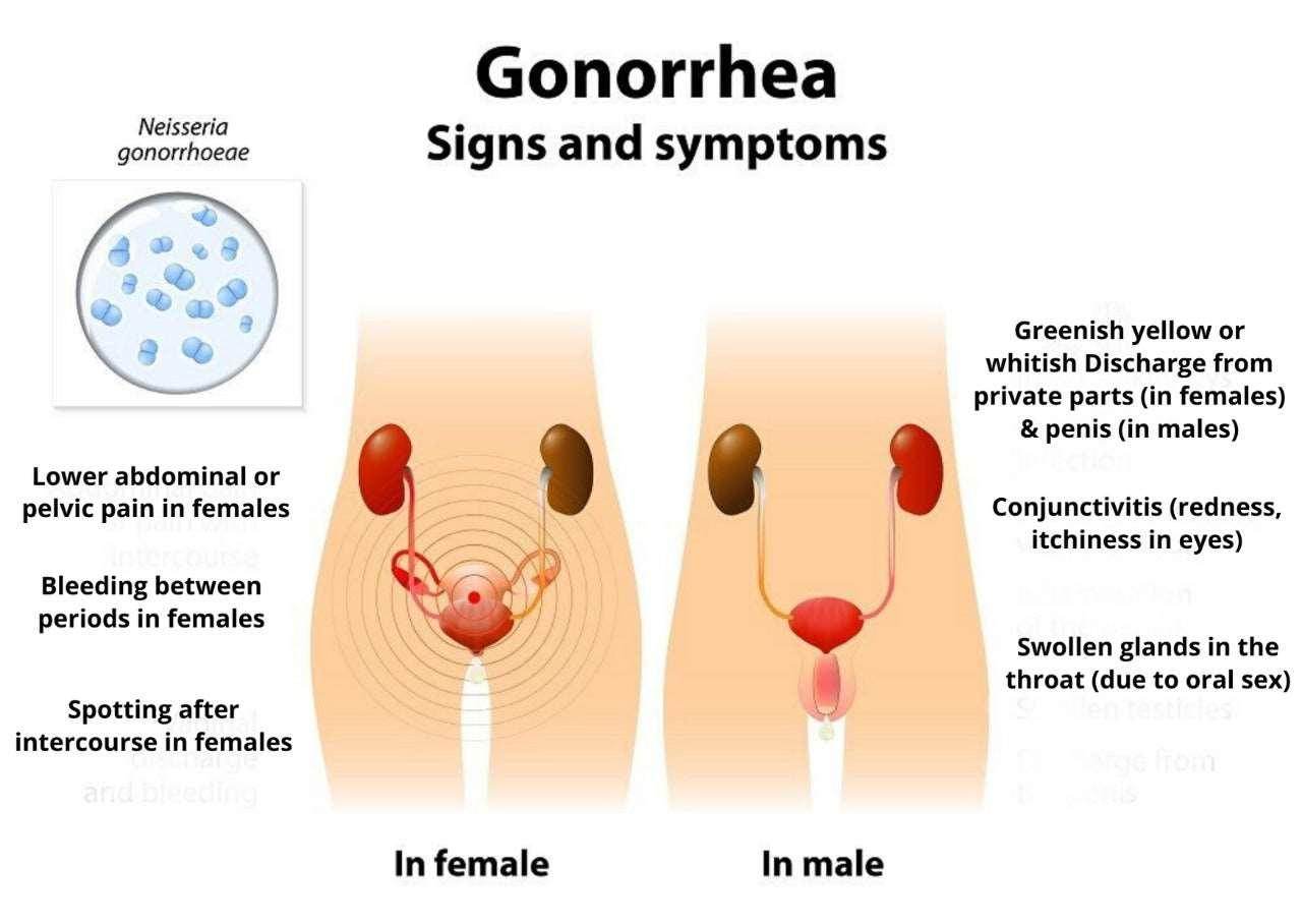 Gonorrhea Treatment Clinic & Cost - SKINFUDGE Aesthetics | Painless, No Side Effects, Natural Looking Results