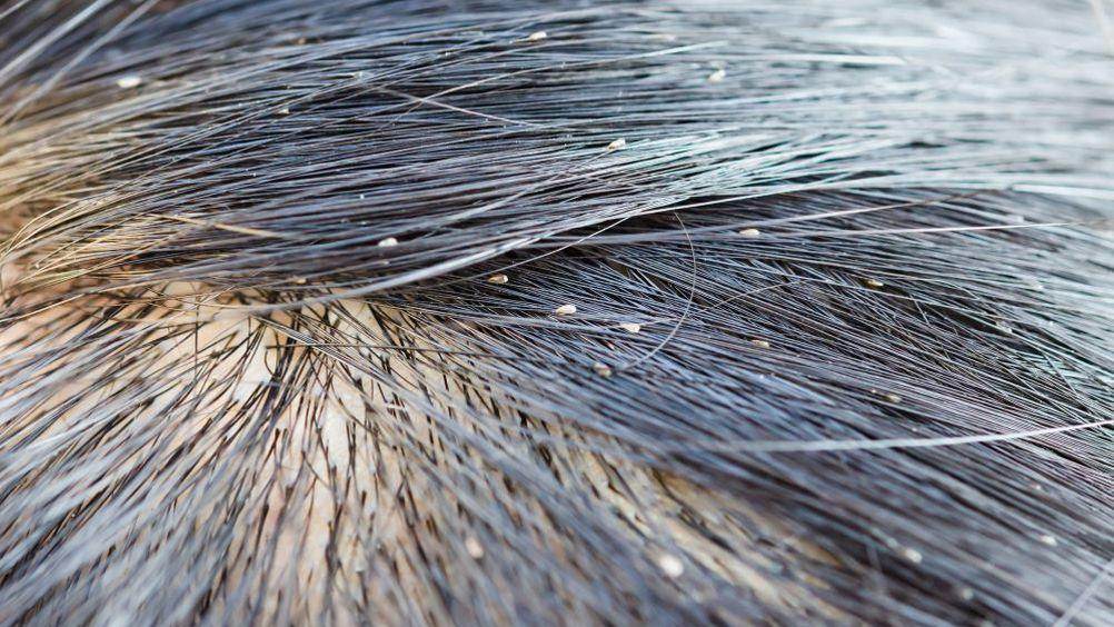 Understanding the Best Lice Treatment Options for Your Family in Pakistan - SKINFUDGE Aesthetics | Painless, No Side Effects, Natural Looking Results